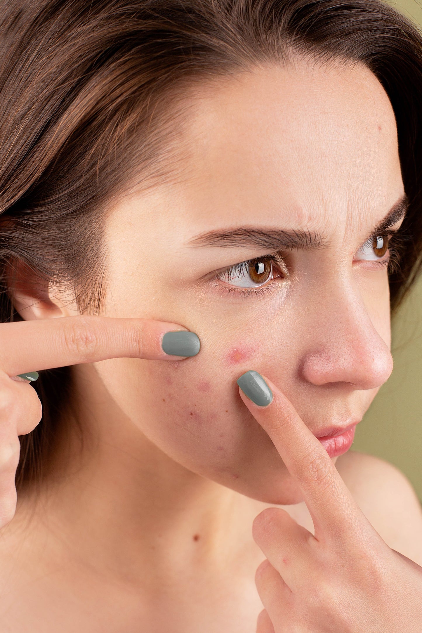 ACNE/PEAU NETTE BIO : SYNERGIE
